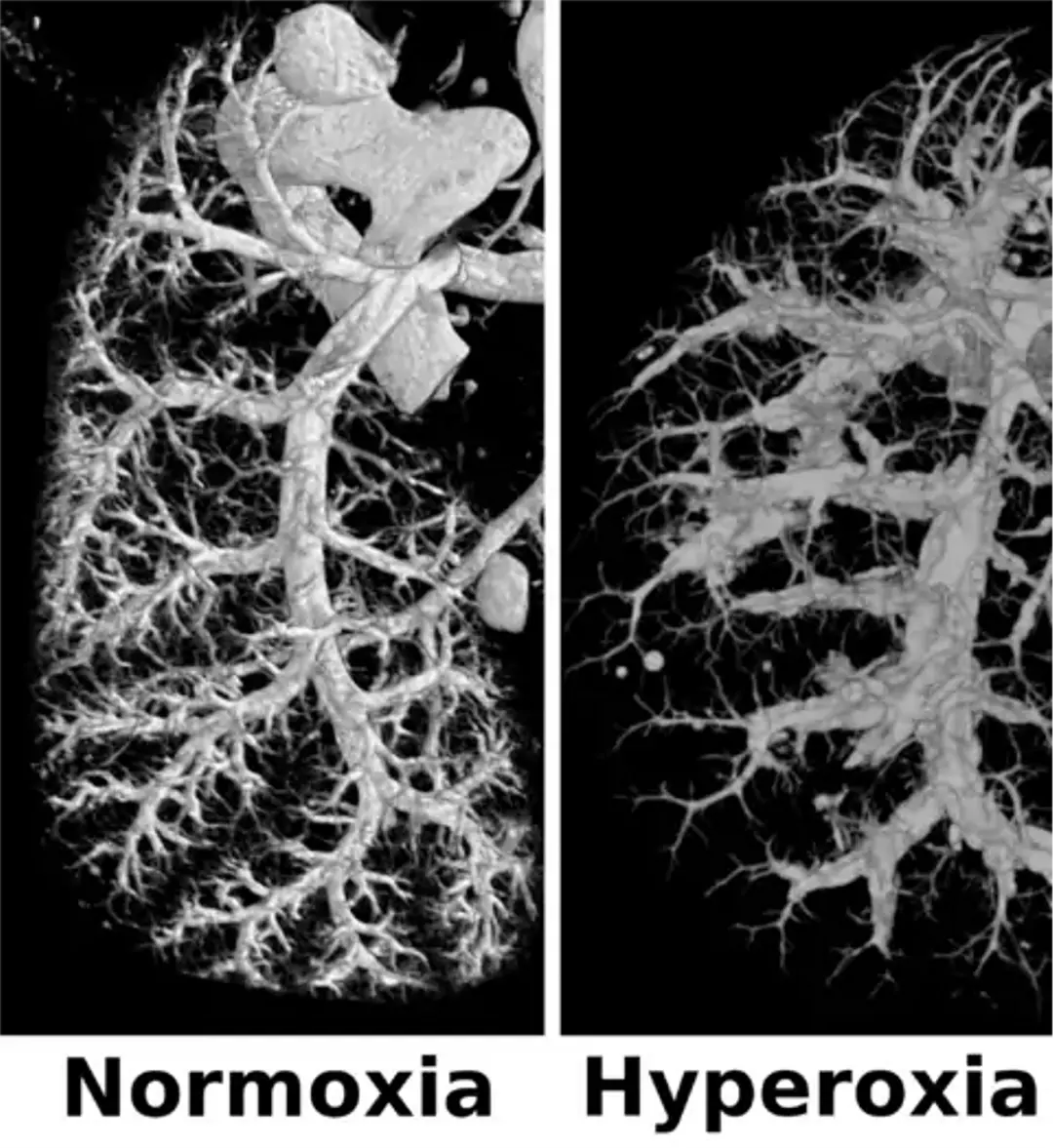 Sprouting Angiogenesis